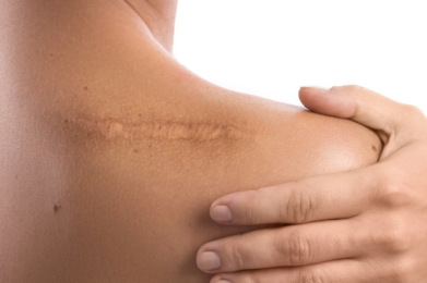 Behandel littekens met ScarWork en MSTR